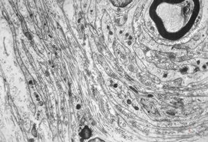 F,12y. | hypertrophic (onion bulb) neuropathy - n.suralis F,12y. | hypertrophic (onion bulb) neuropathy - n.suralis